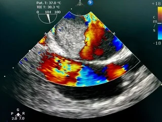 Echocardiogram